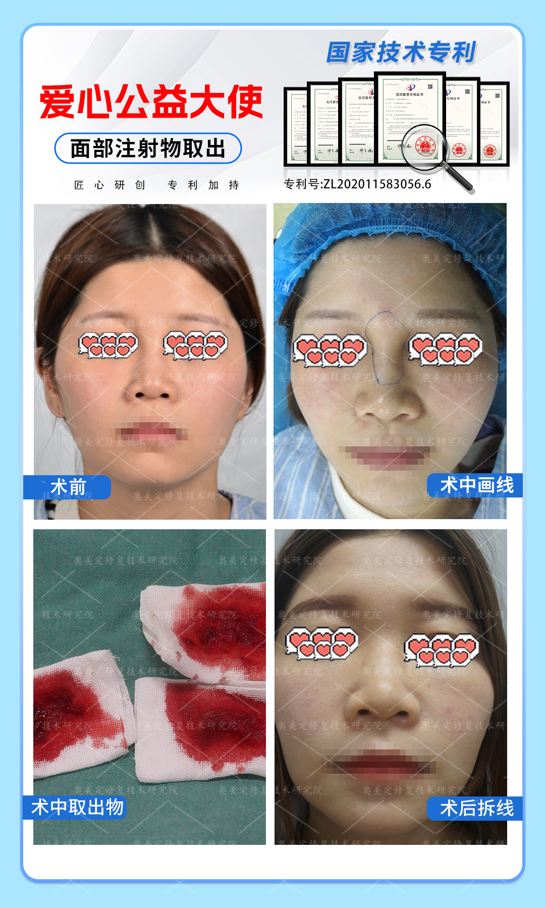 生长因子隆鼻取出修复