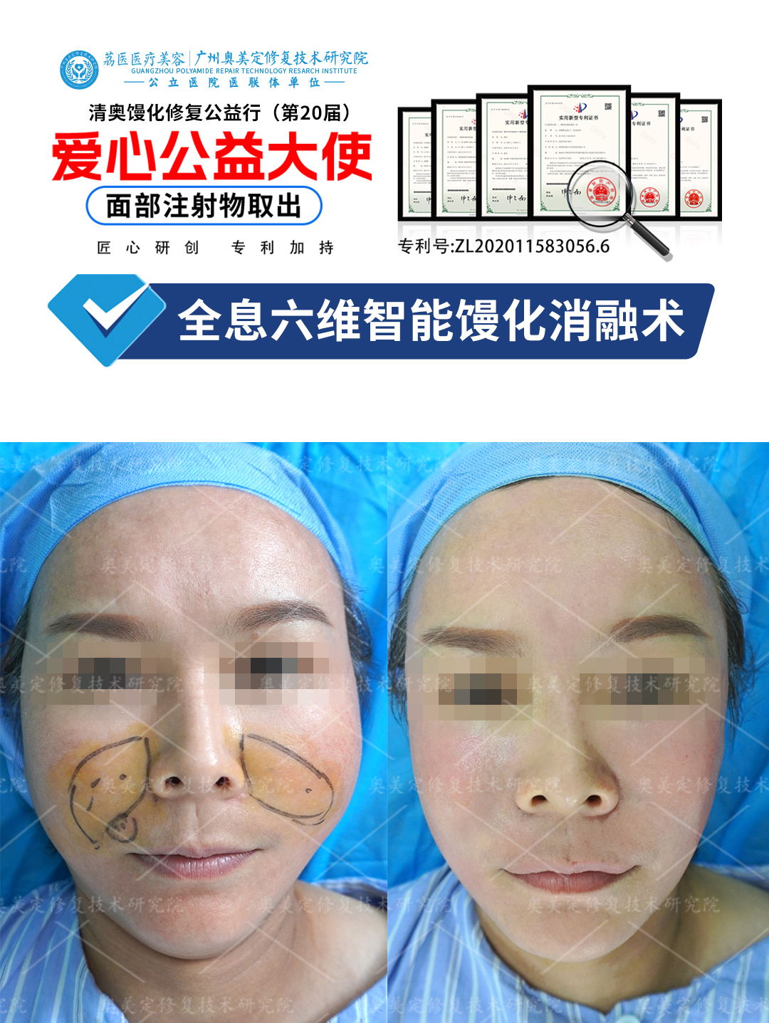 生长因子填充面部后导致增生疯长