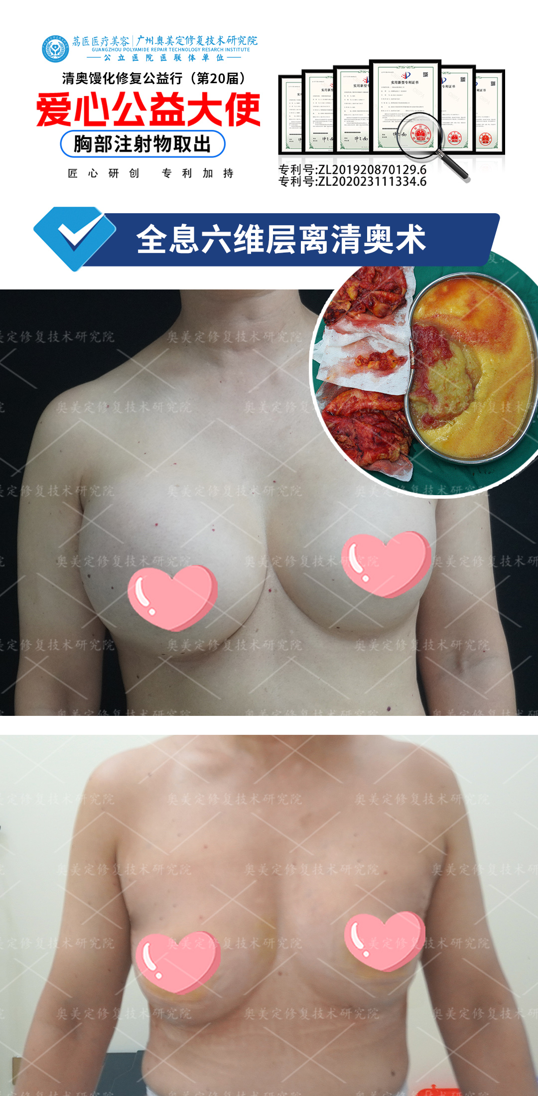 捷克水分子隆胸后如何取出修复