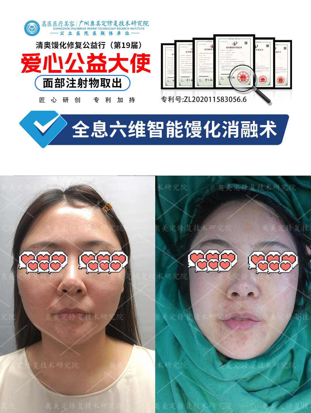 注射填充后成了馒化脸如何修复