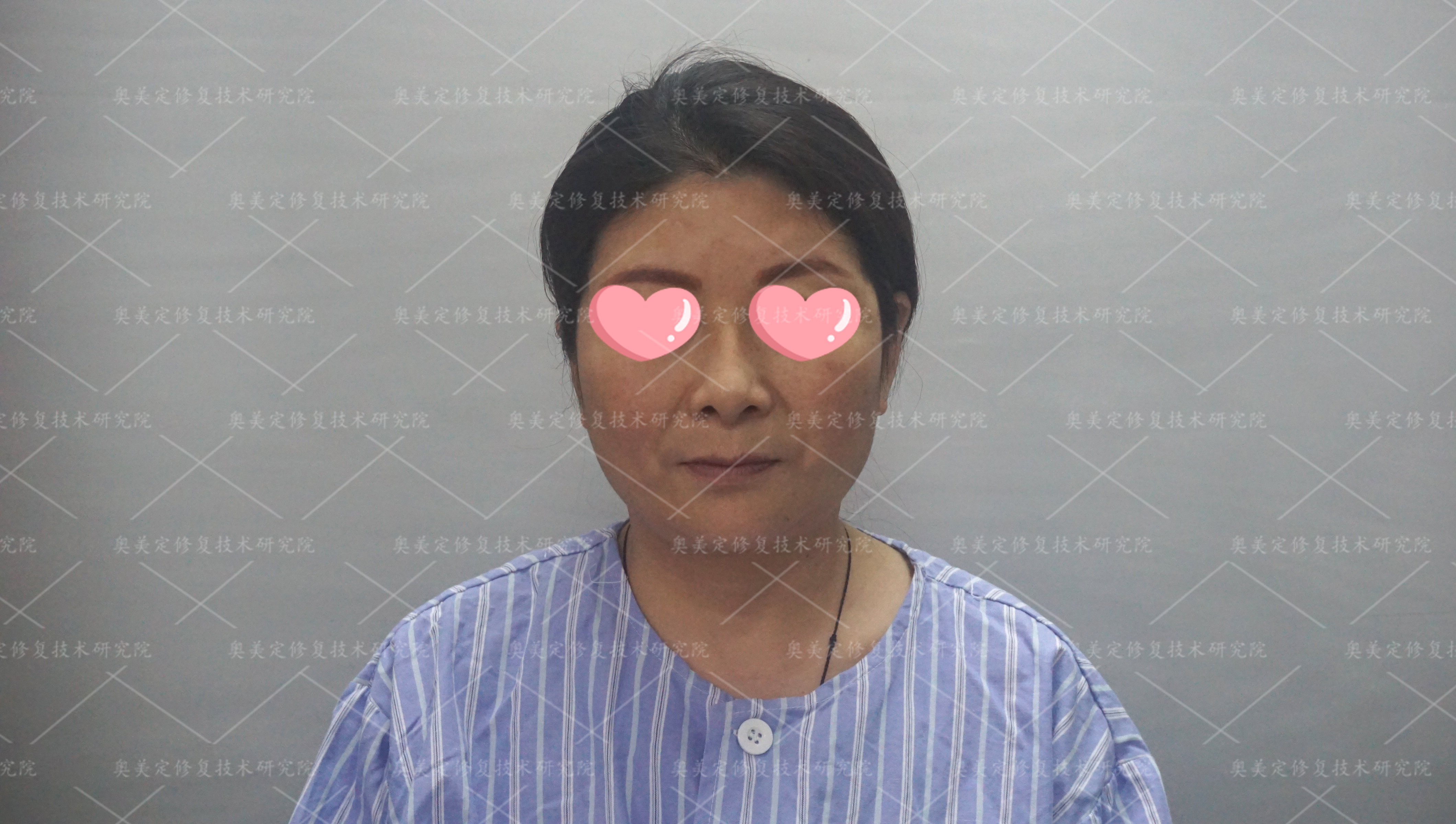 面部注射了奥美定如何取出？