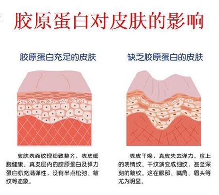 胶原蛋白注射后注意事项：科学护理提升效果与安全性