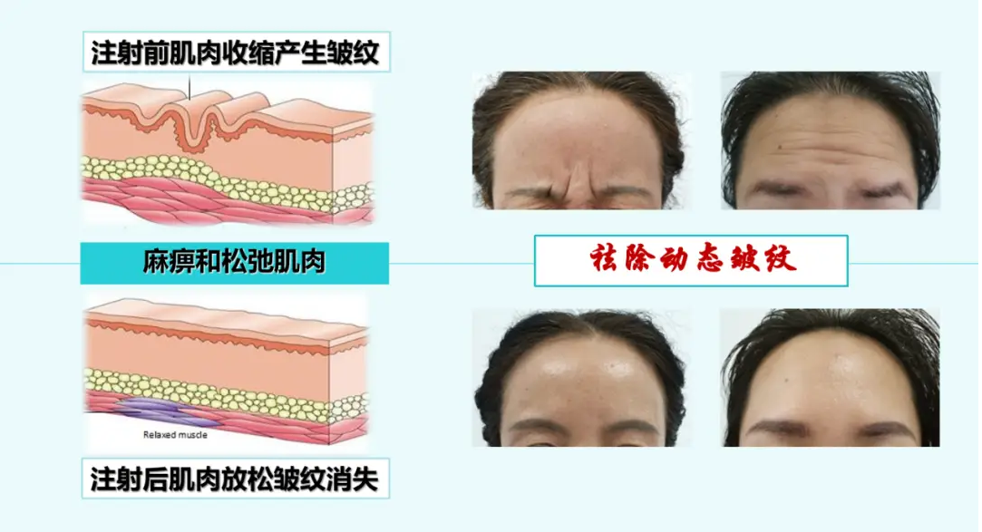 肉毒素打完多久有效果