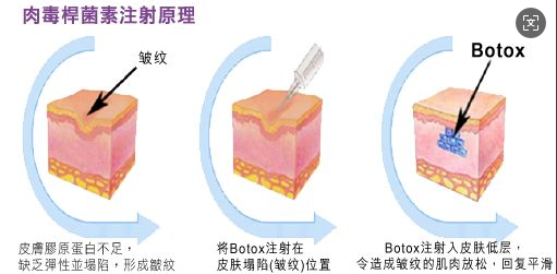 玻尿酸与肉毒素：抗衰界“黄金搭档”，到底有什么区别？