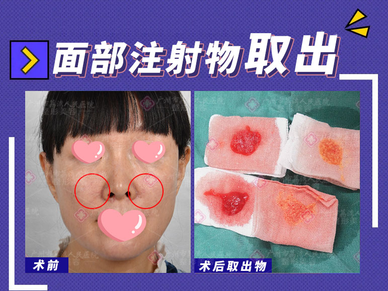 奥美定取出需要多长时间?
